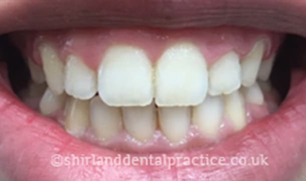 After: Crowded incisors, Six Month Smiles