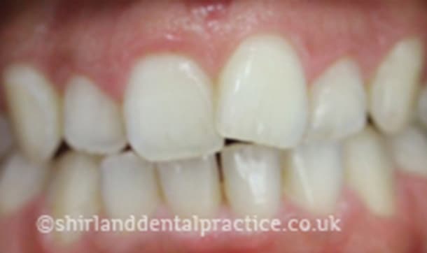 Before: Crowded incisors, Six Month Smiles