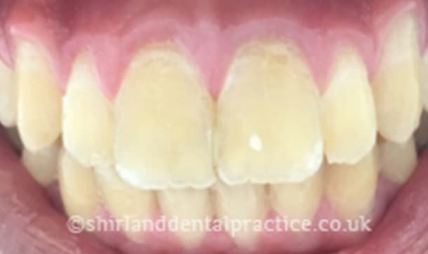 After: Anterior open bite, Six Month Smiles