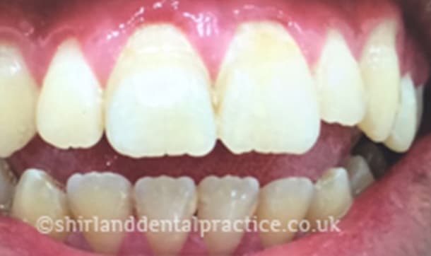 Before: Anterior open bite, Six Month Smiles