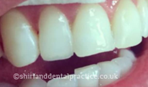 After: Uneven edges, Composite bonding