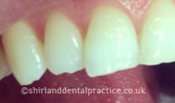 Before: Uneven edges, Composite bonding