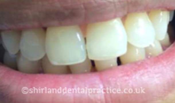 After: Gap between front teeth, Composite bonding