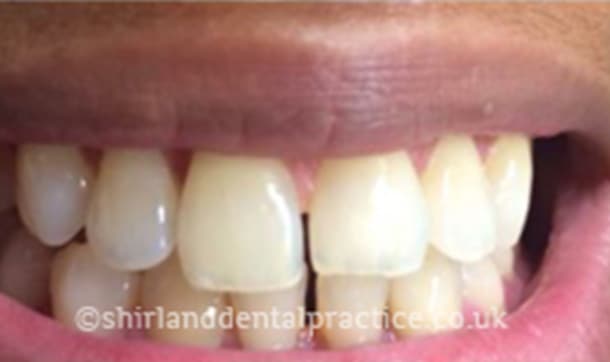 Before: Gap between front teeth, Composite bonding