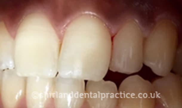 After: Peg-shaped incisor, Composite bonding