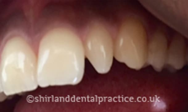 Before: Peg-shaped incisor, Composite bonding