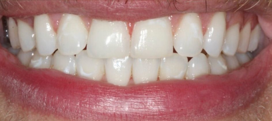 After: Invisalign treatment at Shirland Dental Practice, before and after