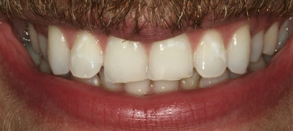 Before: Invisalign treatment at Shirland Dental Practice, before and after