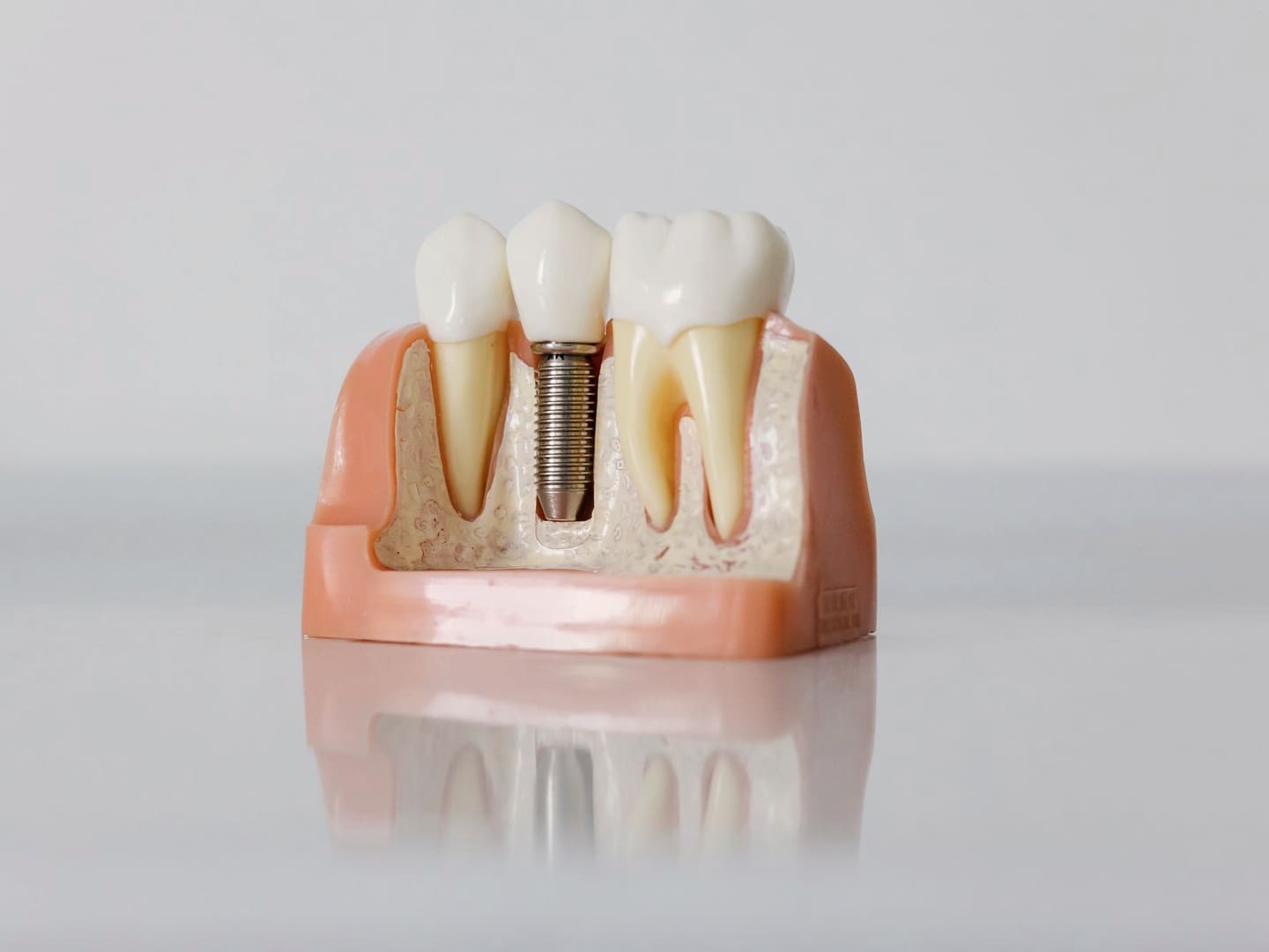 Dental implants at Shirland Dental Maida Vale